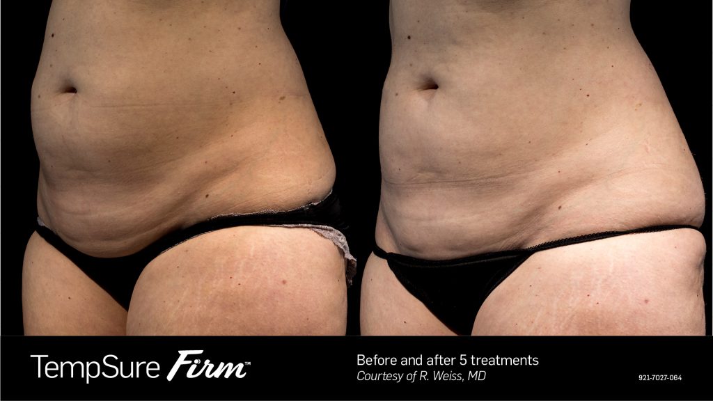 Non Surgical Fat Reduction & Skin Tightening in Honolulu HI
